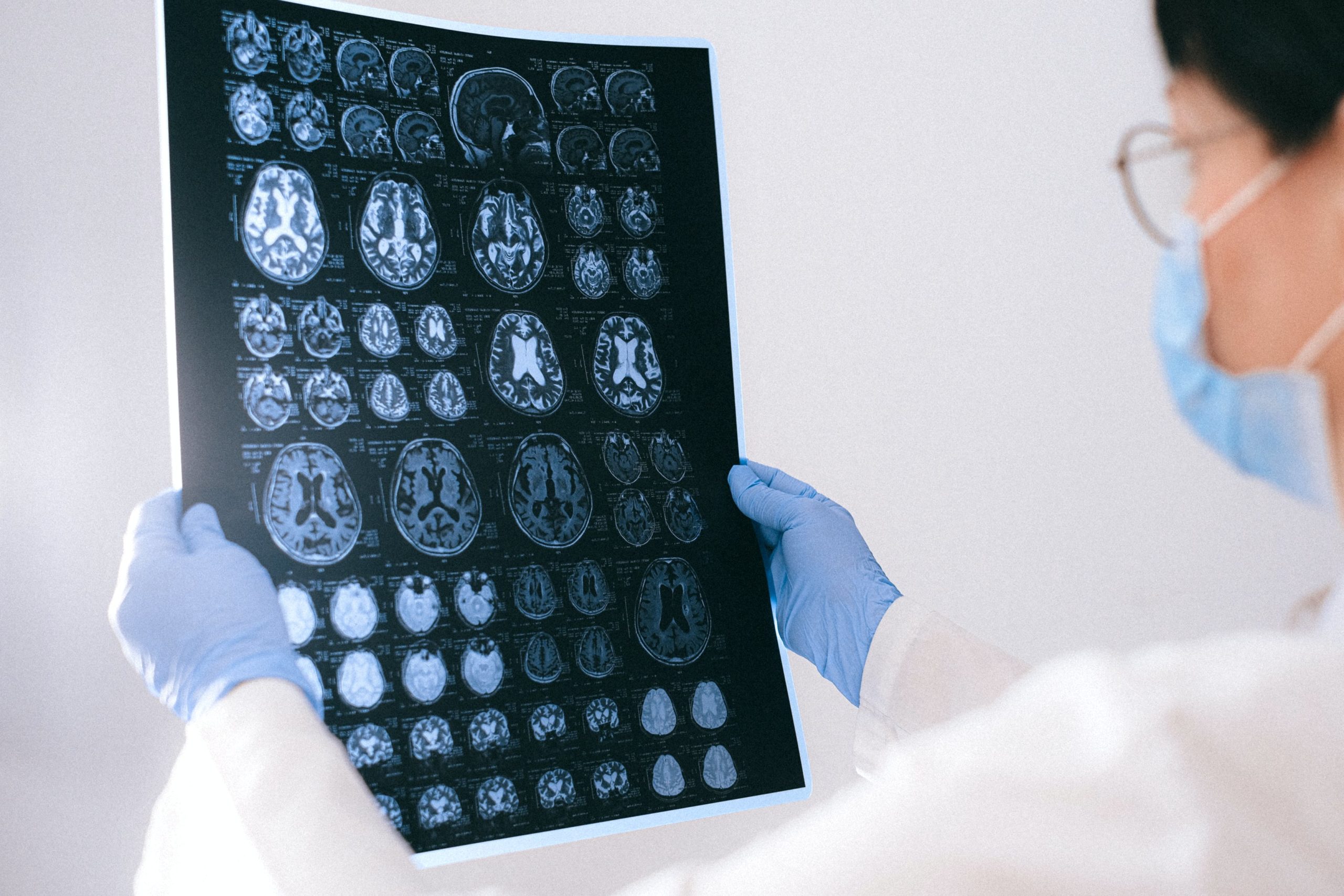 How is an MRI Used to Diagnose Alzheimer's Disease?